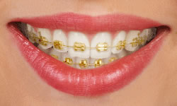 Gold Braces